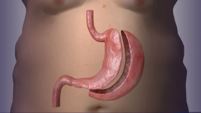 CFM publica resolução que estabelece novos parâmetros para a cirurgia bariátrica e metabólica no Brasil