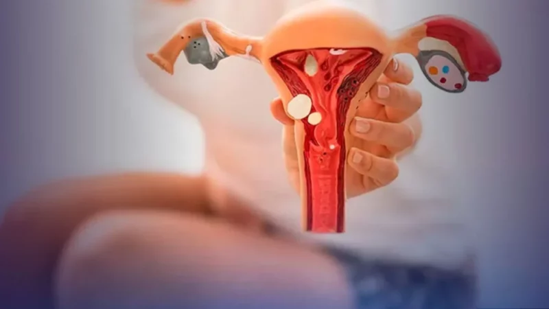 SUS disponibiliza dois novos tratamentos para endometriose em 2025