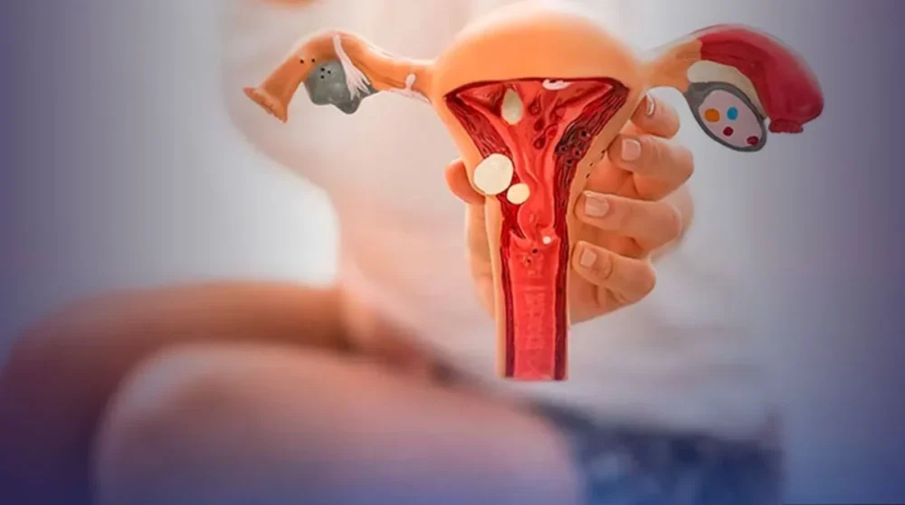 SUS disponibiliza dois novos tratamentos para endometriose em 2025