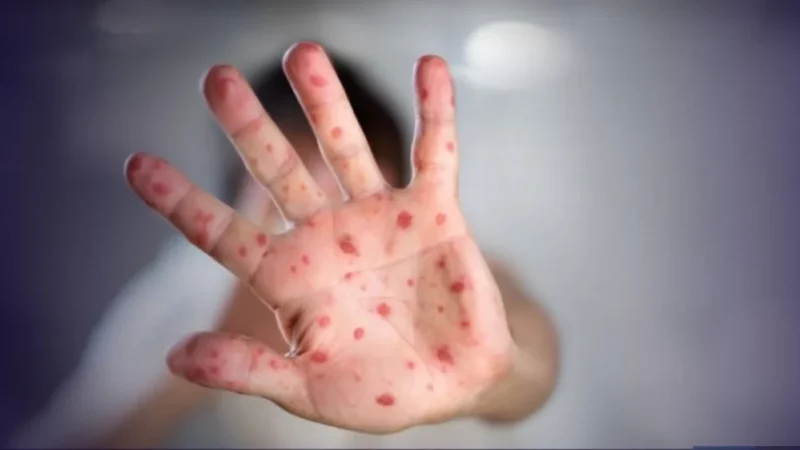 São Paulo registra segundo caso de sarampo importado do ano; Brasil soma 37 casos