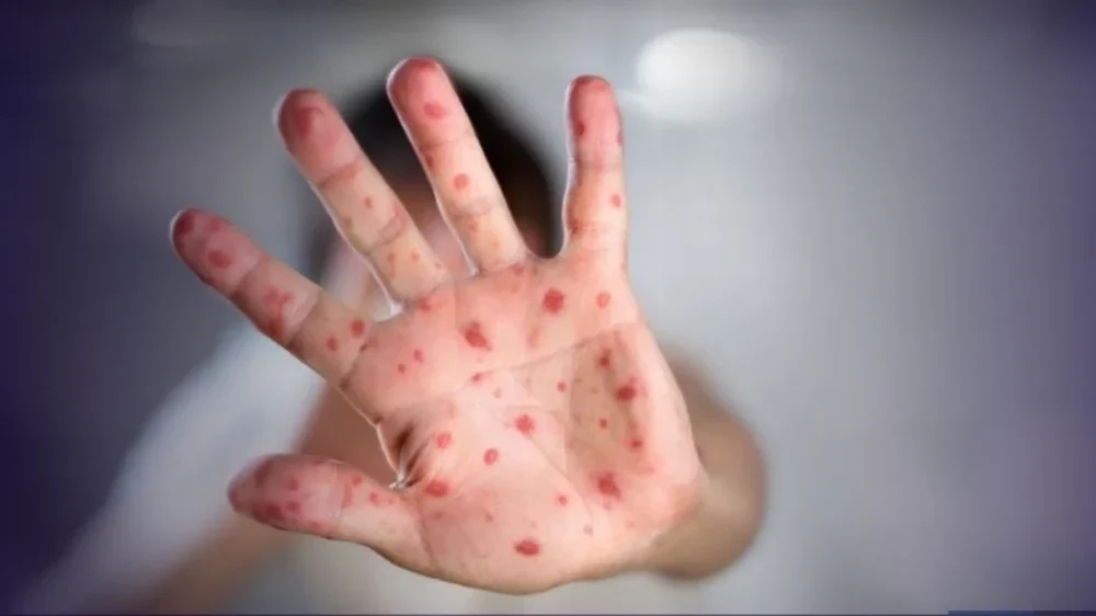 São Paulo registra segundo caso de sarampo importado do ano; Brasil soma 37 casos