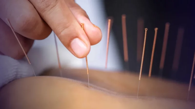 Acupuntura é oficialmente regulamentada como profissão no Brasil
