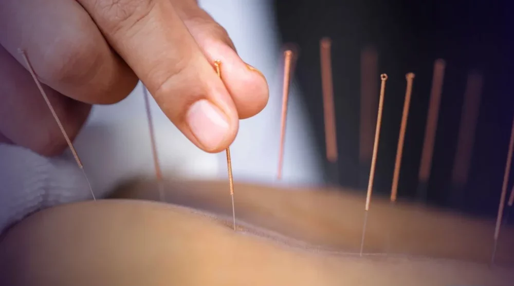 Acupuntura é oficialmente regulamentada como profissão no Brasil